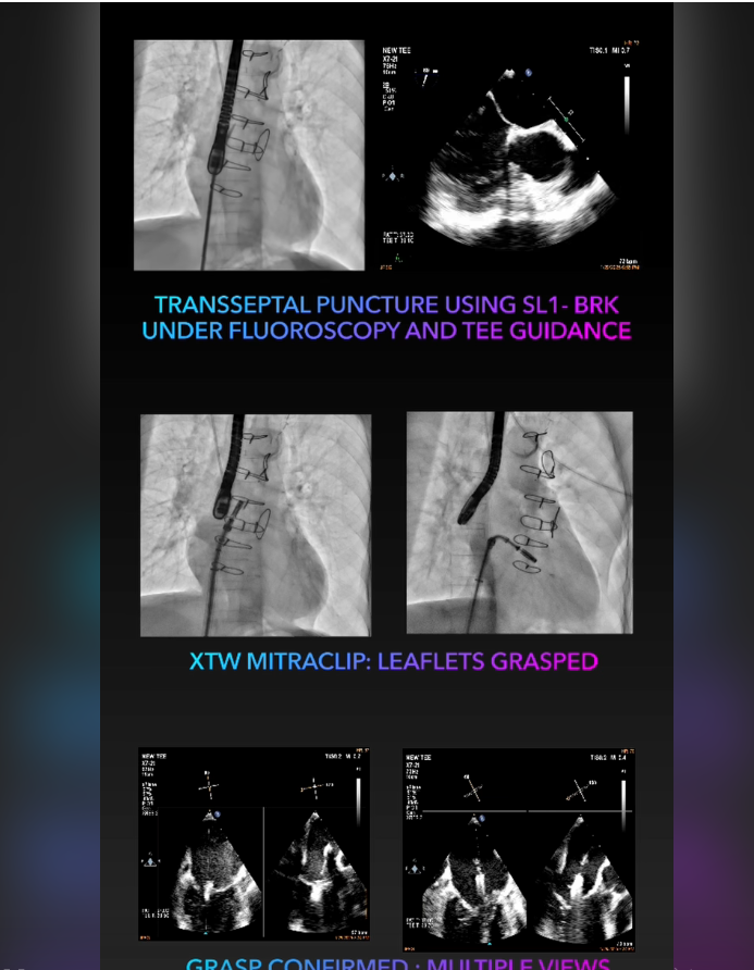 【海外病例分享】混合型MR行M-TEER的腱索缠绕与术中LVEF骤降应对 3e860f66 3676 420f 9768 b76e9d5e34f3